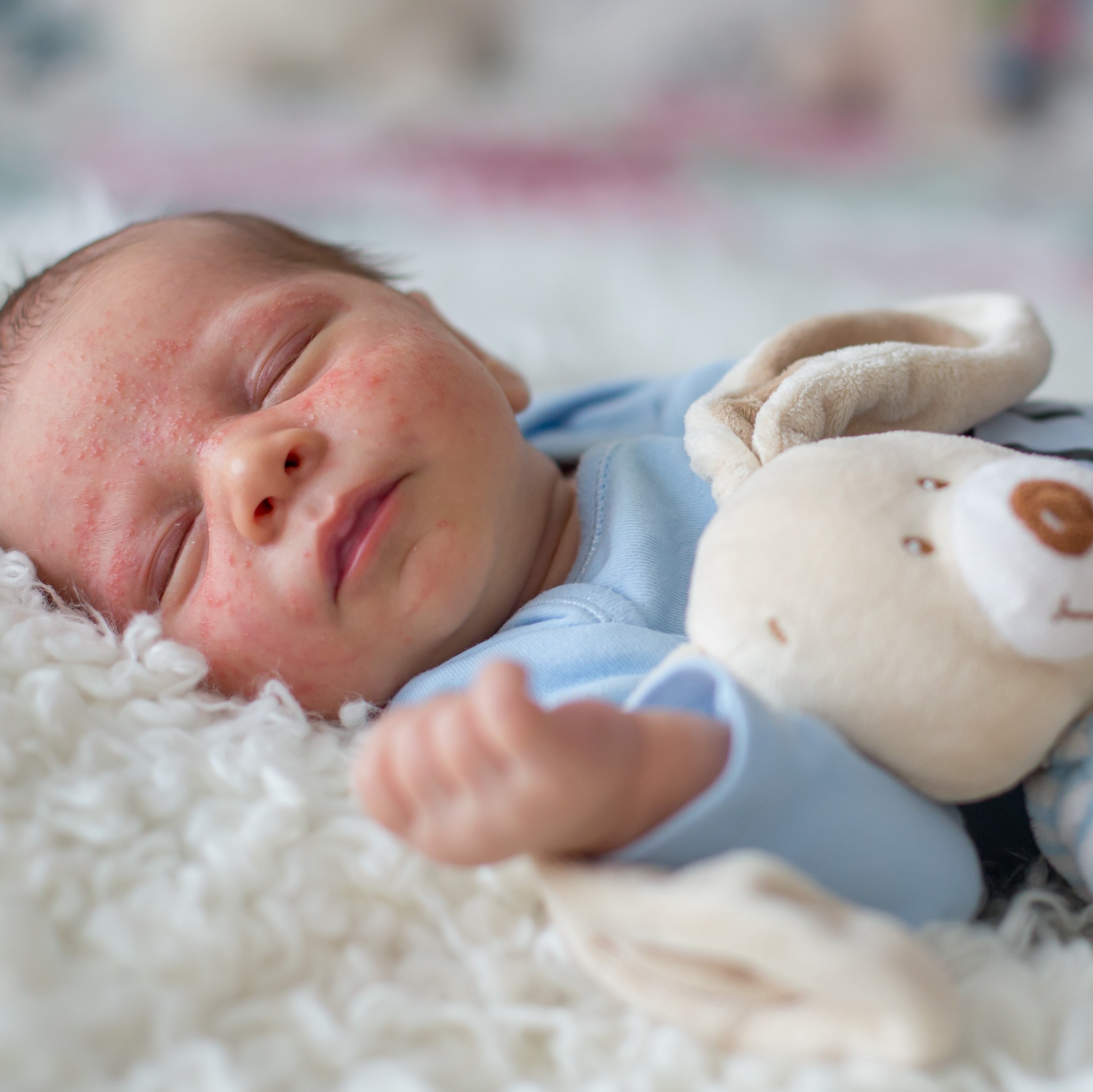 Erfahren Sie, wie Babyakne behandelt wird.